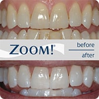 ZOOM Teeth Whitening mesa AZ