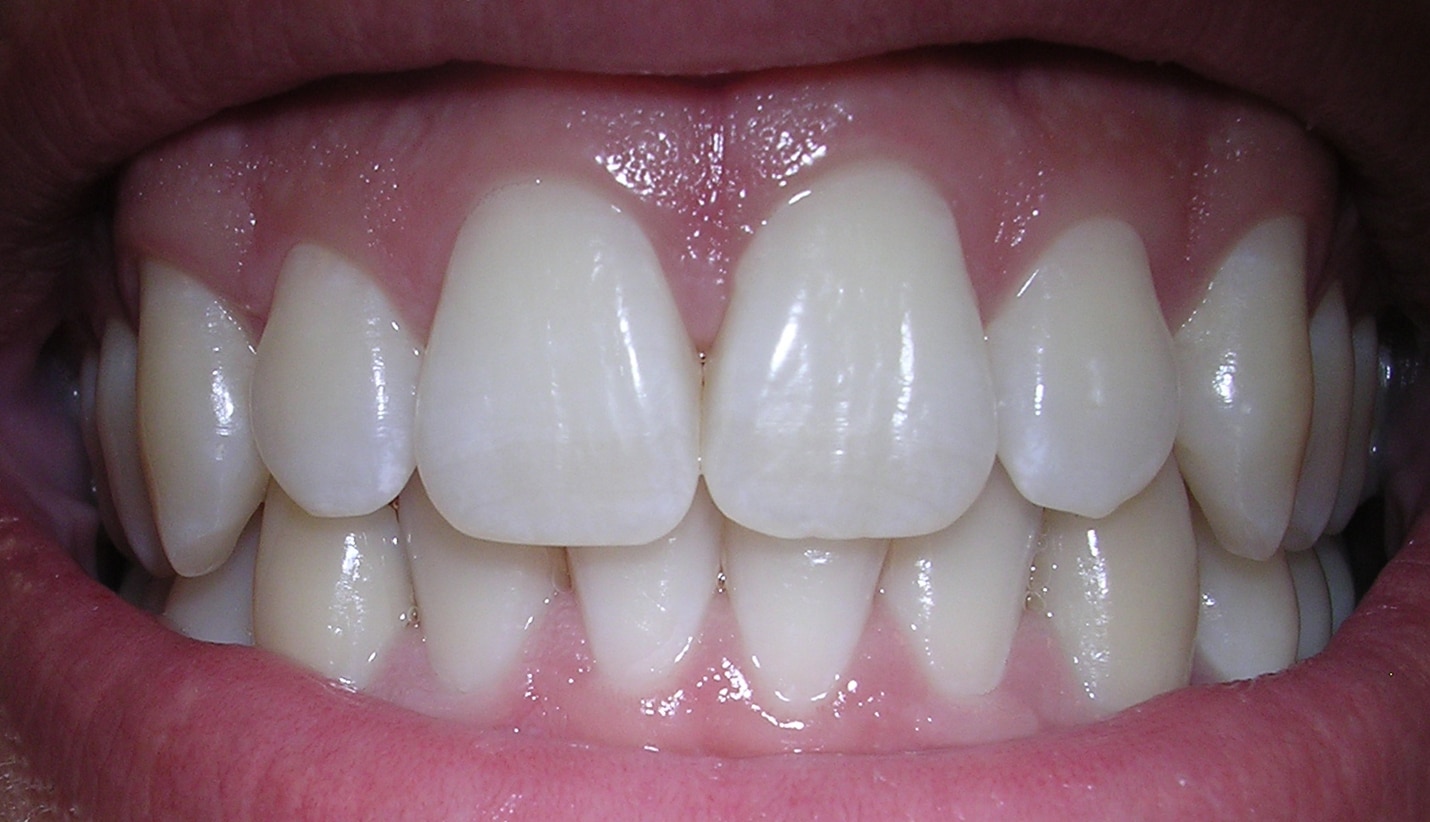 healthy gums