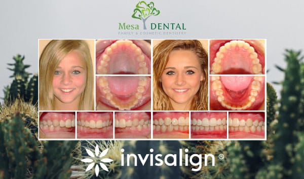 Before and After - Invisalign