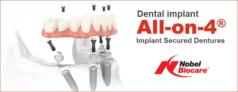 All-on-4 Implant Dentures Graphic